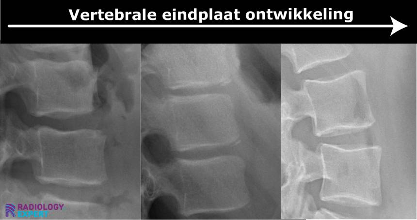 MRI lumbale wervelkolom